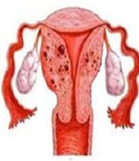 腺筋症と子宮内膜症 - 違いは何ですか？子宮内膜症と腺筋症の違いは何ですか？