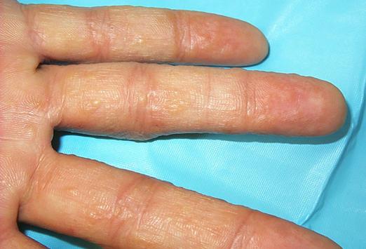 指の上の水様小胞：症候学および治療